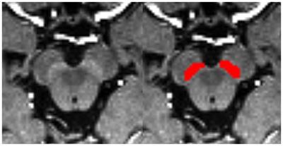 An automated hybrid approach via deep learning and radiomics focused on the midbrain and substantia nigra to detect early-stage Parkinson’s disease